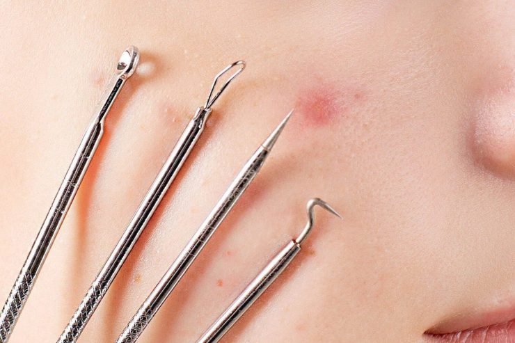 درمان جوش سرسیاه