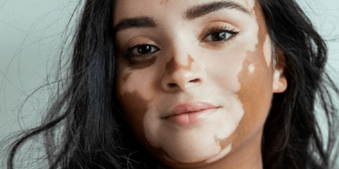 پیسی یا ویتیلیگو