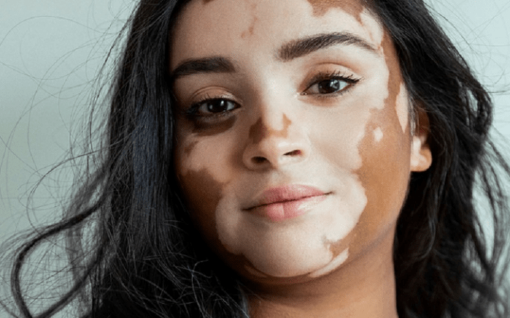 پیسی یا ویتیلیگو