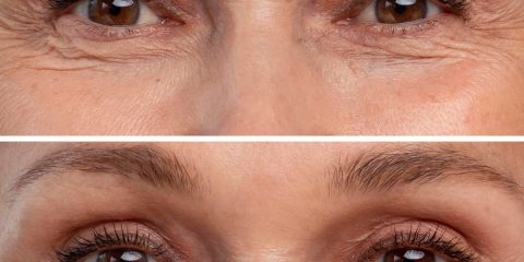 عوارض بوتاکس